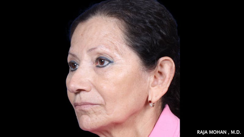 Facelift Before & After Gallery - Patient 145420 - Image 5