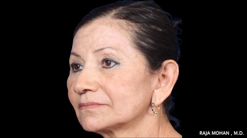 Facelift Before & After Gallery - Patient 145420 - Image 6