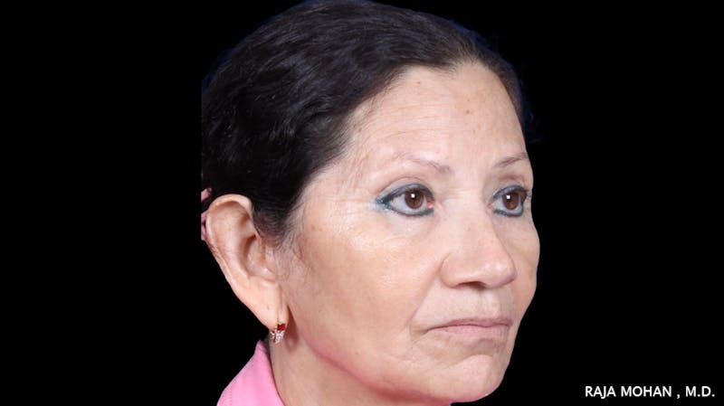 Facelift Before & After Gallery - Patient 145420 - Image 7