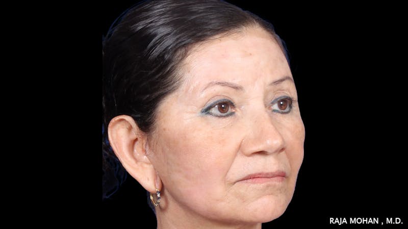 Facelift Before & After Gallery - Patient 145420 - Image 8