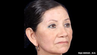 Facelift Before & After Gallery - Patient 145420 - Image 8
