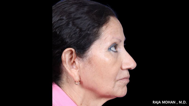 Facelift Before & After Gallery - Patient 145420 - Image 9