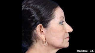 Facelift Before & After Gallery - Patient 145420 - Image 10