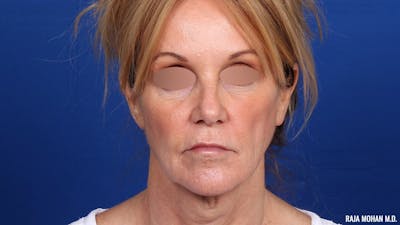 Facelift Before & After Gallery - Patient 101899 - Image 1