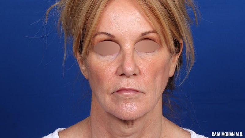 Facelift Before & After Gallery - Patient 101899 - Image 1