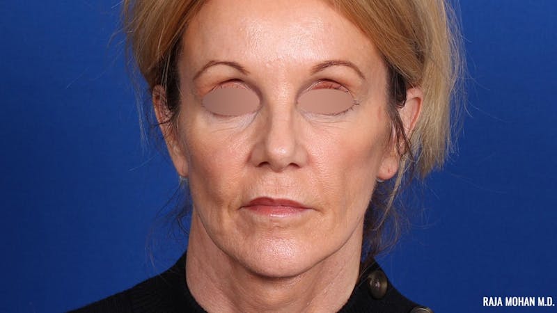 Facelift Before & After Gallery - Patient 101899 - Image 2