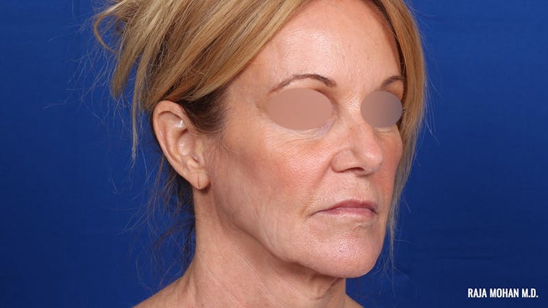 Facelift Before & After Gallery - Patient 101899 - Image 3