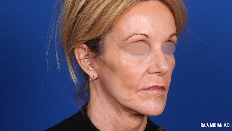 Facelift Before & After Gallery - Patient 101899 - Image 4