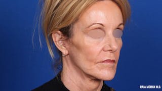 Facelift Before & After Gallery - Patient 101899 - Image 4