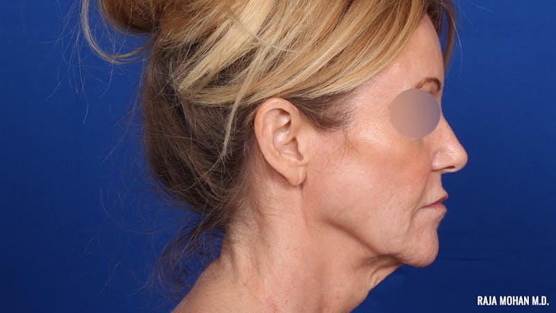 Facelift Before & After Gallery - Patient 101899 - Image 5
