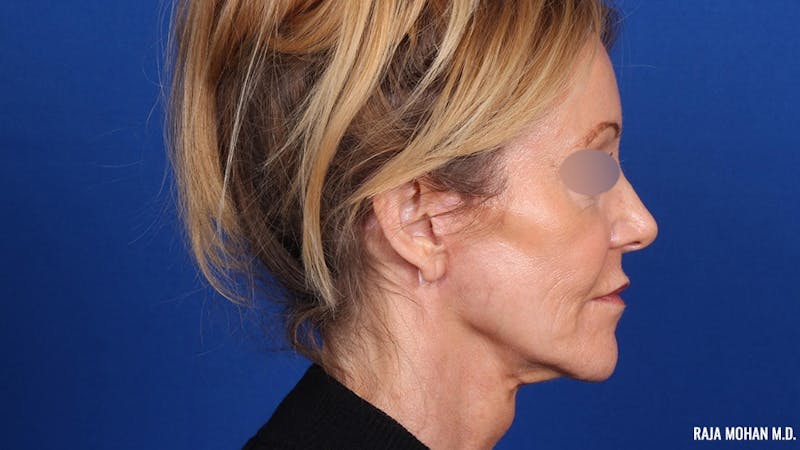 Facelift Before & After Gallery - Patient 101899 - Image 6