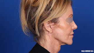 Facelift Before & After Gallery - Patient 101899 - Image 6