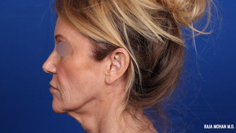 Facelift Before & After Gallery - Patient 101899 - Image 7