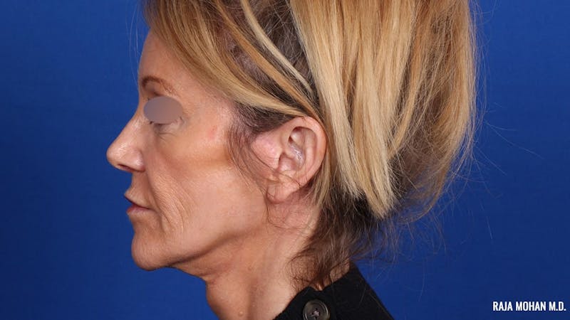 Facelift Before & After Gallery - Patient 101899 - Image 8