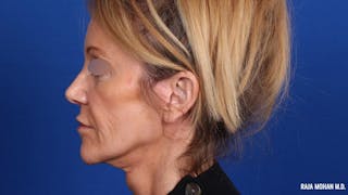 Facelift Before & After Gallery - Patient 101899 - Image 8