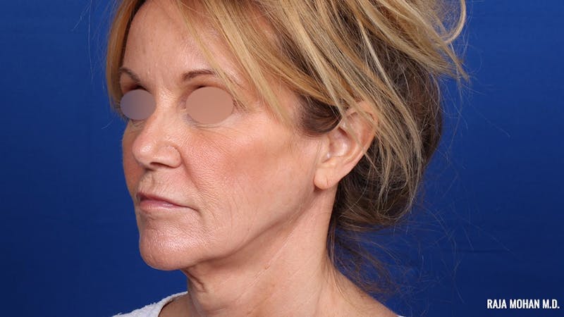 Facelift Before & After Gallery - Patient 101899 - Image 9
