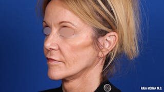 Facelift Before & After Gallery - Patient 101899 - Image 10