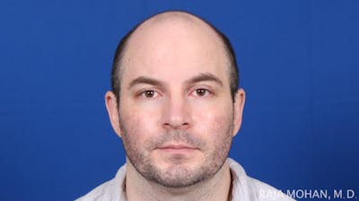 Facelift Before & After Gallery - Patient 308498 - Image 1