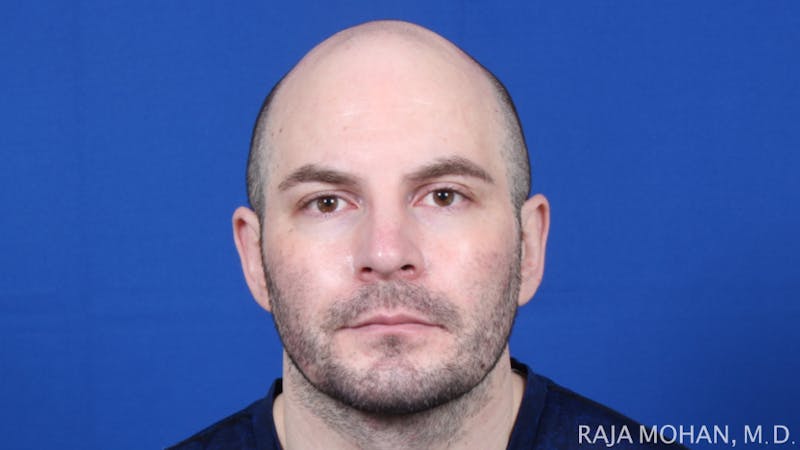 Facelift Before & After Gallery - Patient 308498 - Image 2