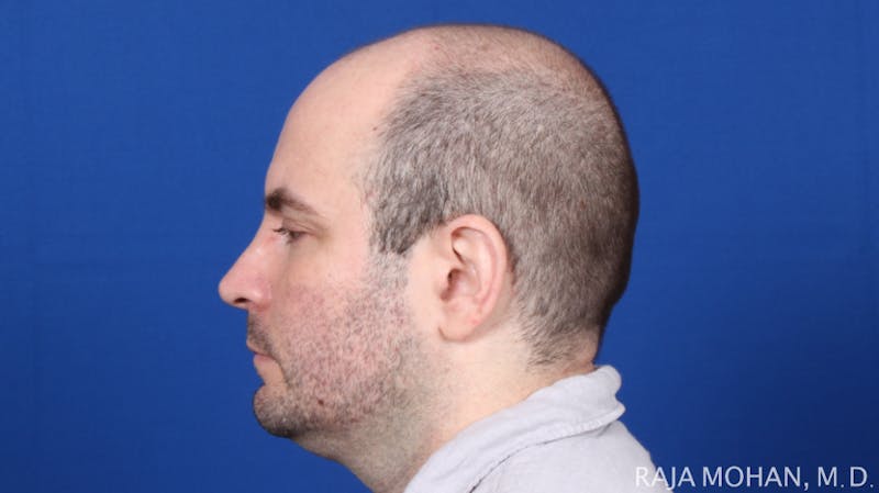 Facelift Before & After Gallery - Patient 308498 - Image 3