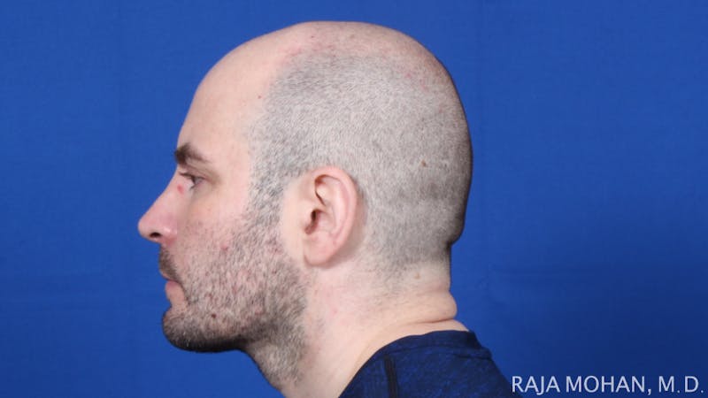 Facelift Before & After Gallery - Patient 308498 - Image 4