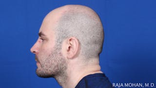 Facelift Before & After Gallery - Patient 308498 - Image 4
