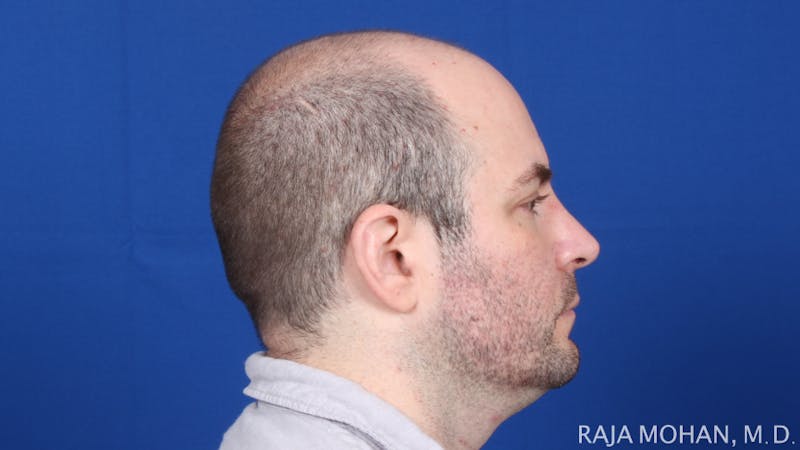 Facelift Before & After Gallery - Patient 308498 - Image 5
