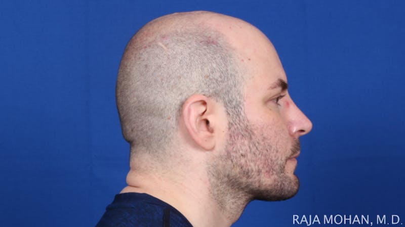 Facelift Before & After Gallery - Patient 308498 - Image 6