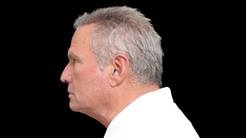 Facelift Before & After Gallery - Patient 392757 - Image 5