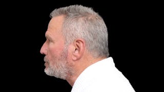 Facelift Before & After Gallery - Patient 392757 - Image 6