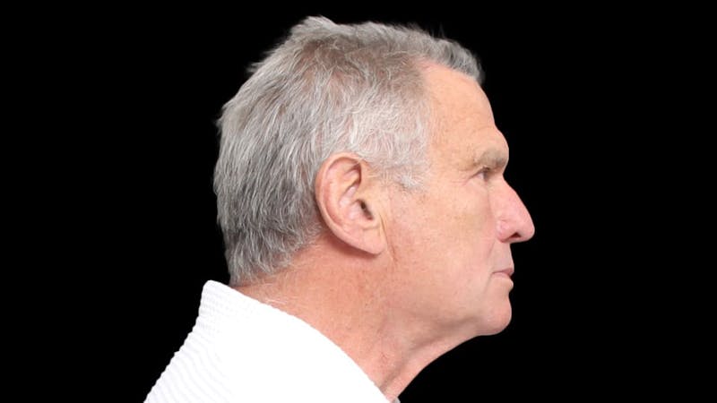 Facelift Before & After Gallery - Patient 392757 - Image 7