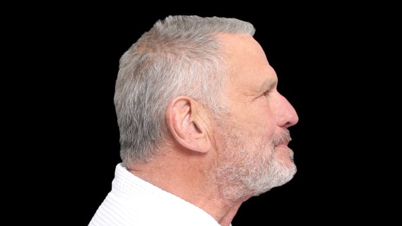Facelift Before & After Gallery - Patient 392757 - Image 8