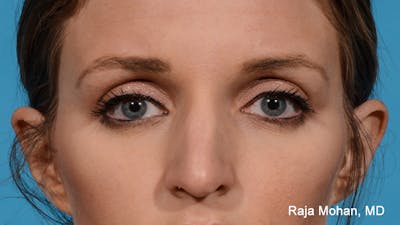 Rhinoplasty Before & After Gallery - Patient 163282 - Image 1