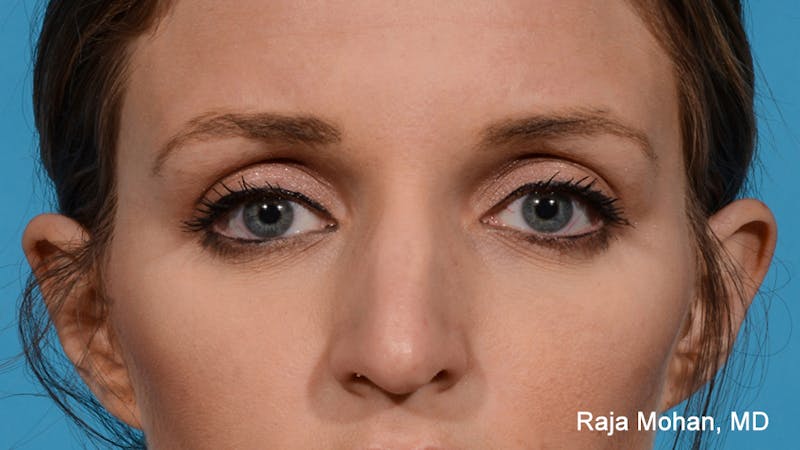 Rhinoplasty Before & After Gallery - Patient 163282 - Image 1