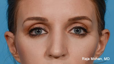 Rhinoplasty Before & After Gallery - Patient 163282 - Image 2