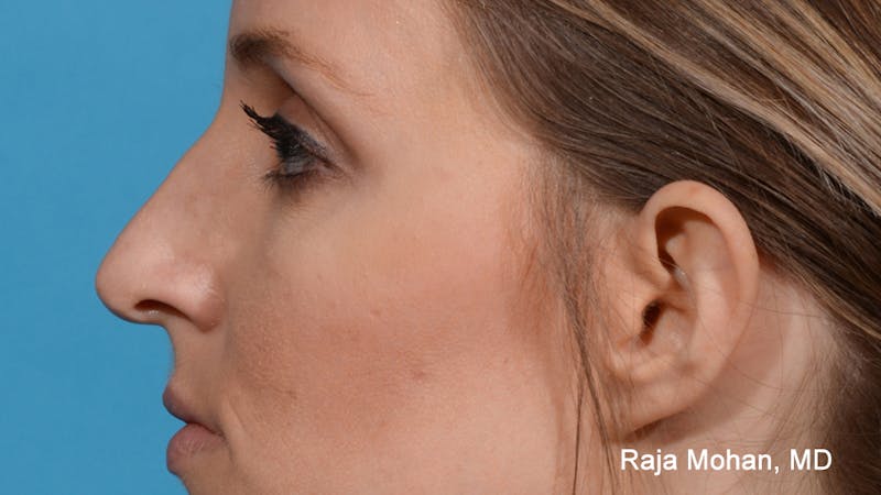Rhinoplasty Before & After Gallery - Patient 163282 - Image 3