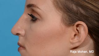 Rhinoplasty Before & After Gallery - Patient 163282 - Image 4