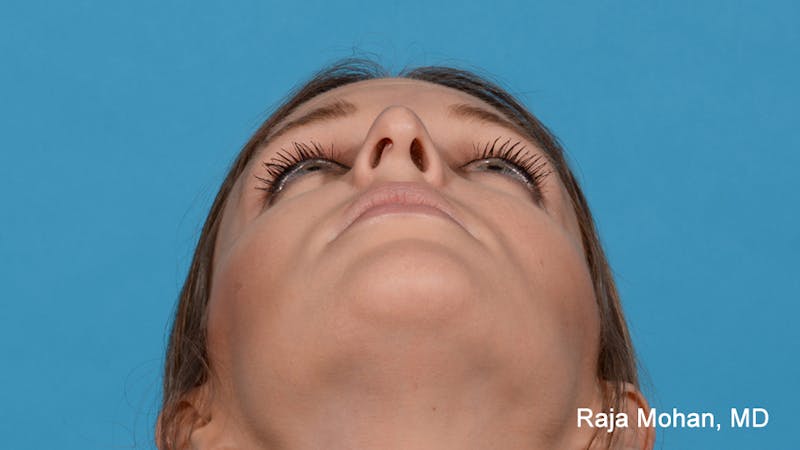 Rhinoplasty Before & After Gallery - Patient 163282 - Image 5