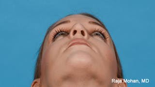 Rhinoplasty Before & After Gallery - Patient 163282 - Image 6