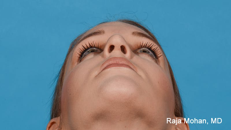 Rhinoplasty Before & After Gallery - Patient 163282 - Image 6