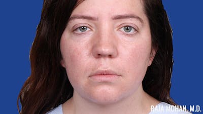 Rhinoplasty Before & After Gallery - Patient 250330 - Image 1