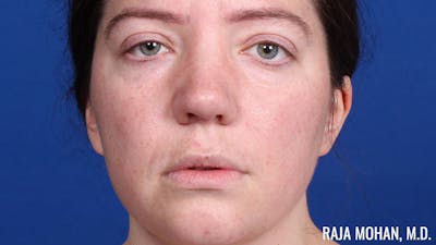 Rhinoplasty Before & After Gallery - Patient 250330 - Image 2