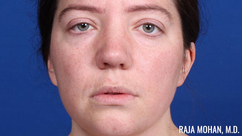 Rhinoplasty Before & After Gallery - Patient 250330 - Image 2