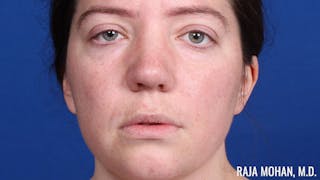Rhinoplasty Before & After Gallery - Patient 250330 - Image 2