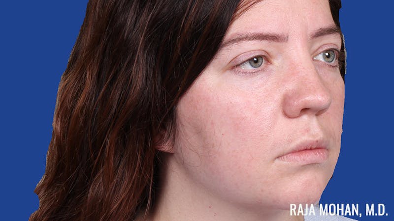 Rhinoplasty Before & After Gallery - Patient 250330 - Image 3
