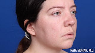 Rhinoplasty Before & After Gallery - Patient 250330 - Image 4