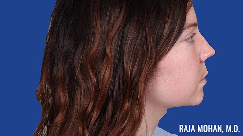 Rhinoplasty Before & After Gallery - Patient 250330 - Image 5