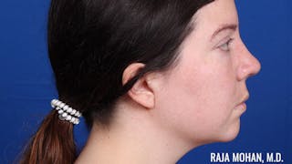Rhinoplasty Before & After Gallery - Patient 250330 - Image 6