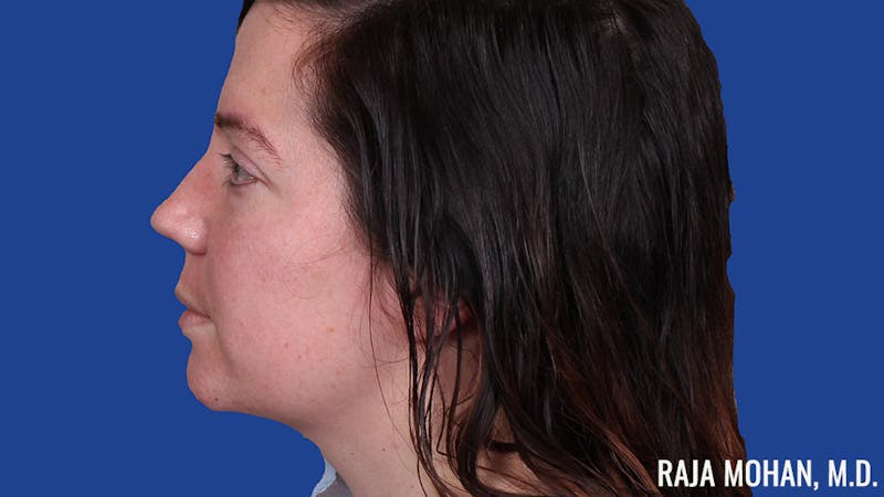 Rhinoplasty Before & After Gallery - Patient 250330 - Image 7