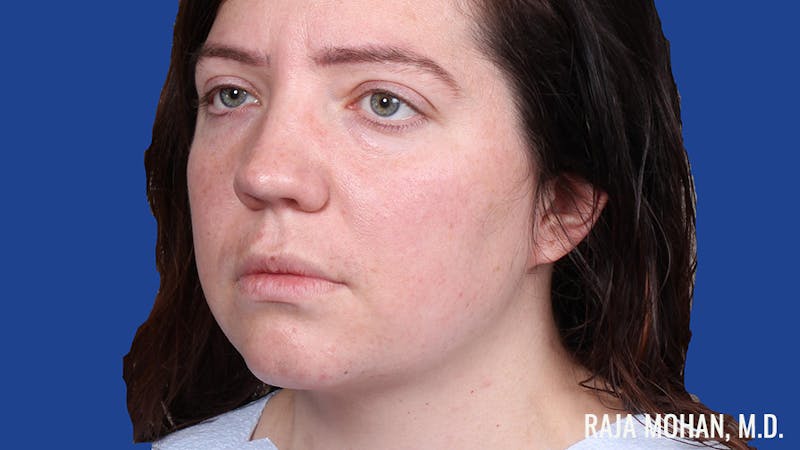 Rhinoplasty Before & After Gallery - Patient 250330 - Image 9